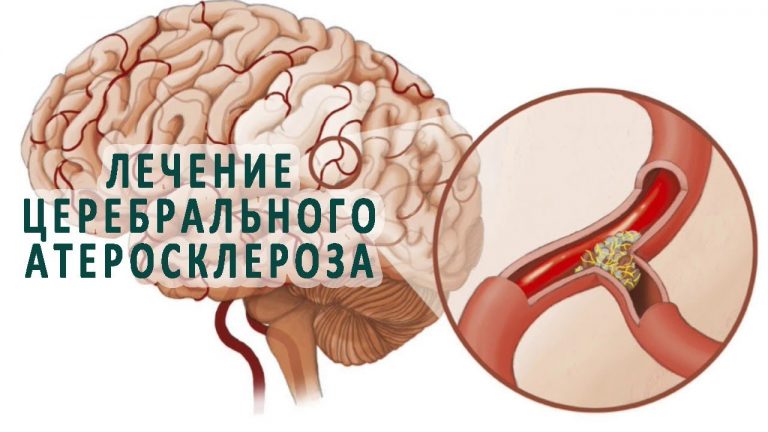 Цвз на фоне атеросклероза сосудов головного мозга